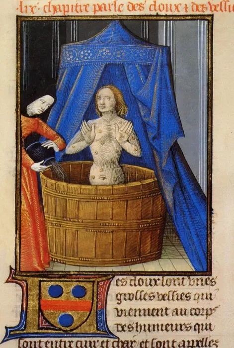 Framed Print : Treatment of boils with a hot herbal bath. From Livre des propriétés des choses by Barthélemy l'Angl Creator: Anonymous Framed Print : Treatment of boils with a hot herbal bath. From Livre des propriétés des choses by Barthélemy l'Angl Creator: Anonymous