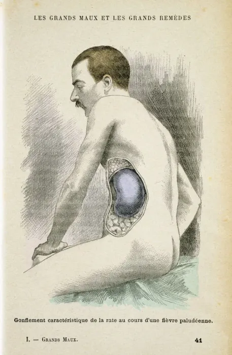 Framed Print : Typical enlarged spleen of a Malaria patient, c1890 Framed Print : Typical enlarged spleen of a Malaria patient, c1890