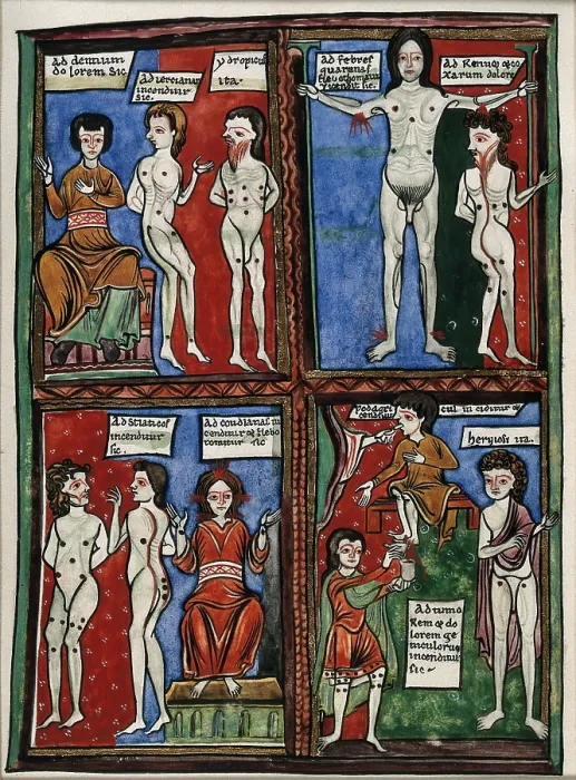 Framed Print : Four vignettes demonstrating different cauterisation points on naked human bodies. Creator: Unknown Framed Print : Four vignettes demonstrating different cauterisation points on naked human bodies. Creator: Unknown