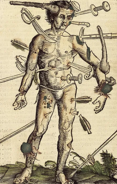 Framed Print : The wound man, 1517. Creator: Hans Wechtlin the Elder Framed Print : The wound man, 1517. Creator: Hans Wechtlin the Elder
