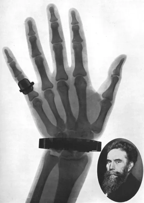 Framed Print : X-ray photograph of a hand, 1926 Framed Print : X-ray photograph of a hand, 1926