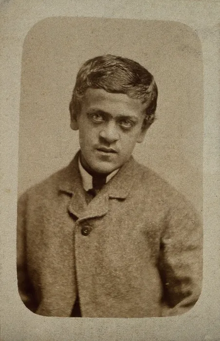 Framed Print : A young man, probably showing some signs of Down's syndrome, c1880s. Creator: Davis & Sons. A young man, probably showing some signs of Down's syndrome, c1880s Framed Print : A young man, probably showing some signs of Down's syndrome, c1880s. Creator: Davis & Sons. A young man, probably showing some signs of Down's syndrome, c1880s