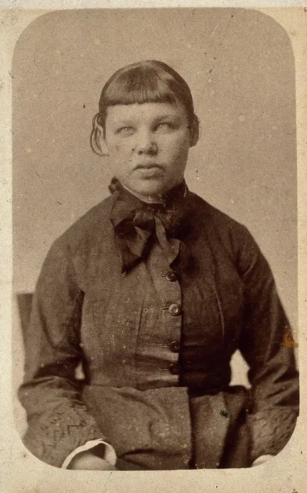 Framed Print : A young woman with a short fringe, showing signs of mental deficiency, c1860s. Creator: John Davis Framed Print : A young woman with a short fringe, showing signs of mental deficiency, c1860s. Creator: John Davis