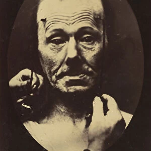 Figure 8: Contraction of the right m. frontalis. 1854-56, printed 1862