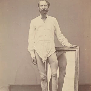 Gunshot Wound of Middle Third of Left Femur, 1865-67. Creator: William H. Bell