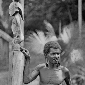 Malformation of the ears, Solomon Islands, 1920. Artist: JW Beattie