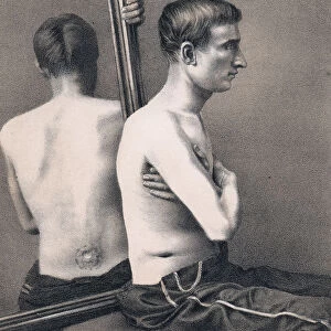 Recovering casualty of a bullet wound to the abdomen, American Civil War, 1865
