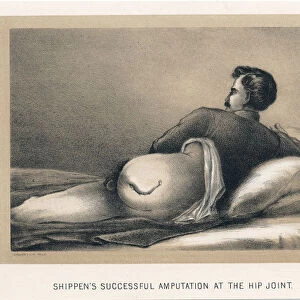 Shippens Successful Amputation at the Hip Joint, American Civil War, 1865