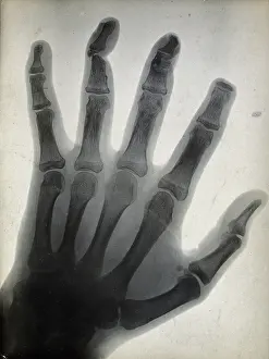 1896 Prints: The bones of a hand, with the tip of the index finger missing, viewed through x-ray, 1896