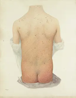 Skin Disease Prints: Back of a boy with skin disease, 1891. Creator: W Toogood Hill