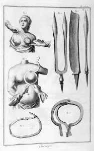 Diderot Gallery: Breast surgery, 1751-1777