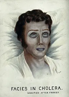 Sickbed Prints: A cholera victim with a typical facial appearance, 1920-1950. Creator: Unknown