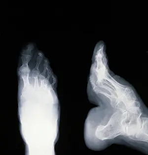 Bone Prints: A deformed foot: X-ray, 20th century. Creator: Unknown