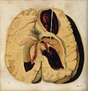 Brain Prints: A diseased brain, 1800-1850. Creator: Richard Bright