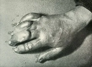 Atkinson Prints: Dr. Atkinsons Frost-Bitten Hand, 5 July 1911, (1913). Artist: Herbert Ponting