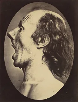 Adrien Tournachon Gallery: Figure 55: Astonishment badly rendered by the subject: a ridiculous and i