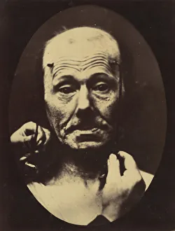 Adrien Tournachon Gallery: Figure 8: Contraction of the right m. frontalis. 1854-56, printed 1862