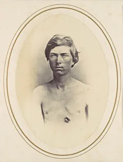 Patient Prints: Frederick A. Bentley, 1865. Creator: Reed Brockway Bontecou