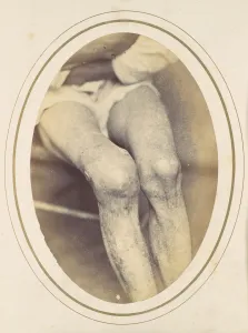 Knee Prints: Frederick Hohmann, 1865. Creator: Reed Brockway Bontecou