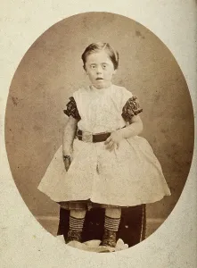 Disability Prints: A girl with Down's syndrome