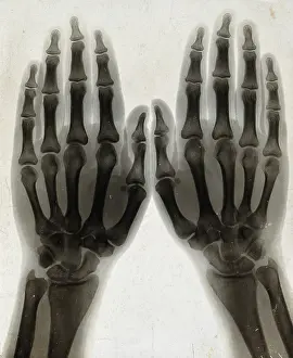 1896 Prints: Two hands, viewed through x-ray, 1896