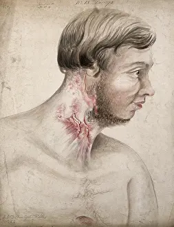1856 Prints: Head and chest of a man with a disease affecting his neck