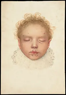 Illustrations Prints: Head of a child with closed eyes and skin disease on the face, 1892. Creator: Unknown