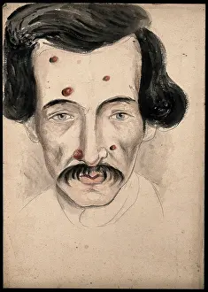 Black Hair Prints: Head of a man with a disease affecting his face