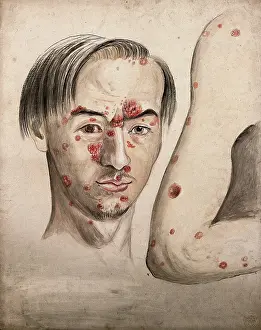 Portion Prints: Head of a man with a severe disease affecting his face; and a section of diseased arm