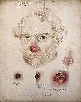 Nose Prints: Head of a man with a severe disease affecting his nose; a detail of the nose