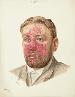Skin Disease Prints: The head of a man with skin disease, July 1889. Creator: W Toogood Hill