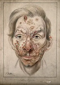 Disfigurement Prints: Head of a man with a syphilitic lesions affecting his face