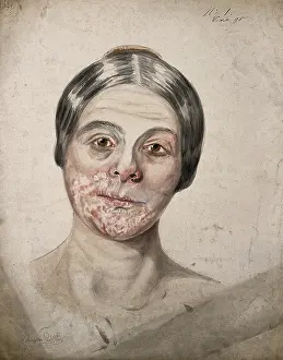 Disfigurement Prints: Head of a woman with a severe disease affecting her face