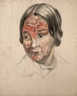 Disfigurement Prints: Head of a woman with a severe disease affecting her face