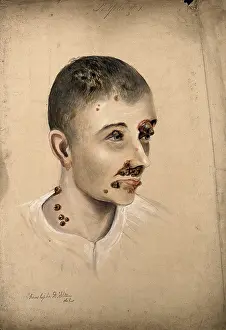 Head of a woman with a severe disease affecting her face and neck, 1864. Creator: Christopher D'Alton. Head of a woman with a severe disease affecting her face and neck, 1864. Creator: Christopher D'Alton