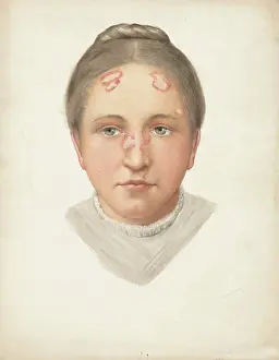 Nose Prints: The head of a young woman with loss of skin on her forehead and nose