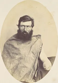 Amputation Prints: Herman Rice, 1865. Creator: Reed Brockway Bontecou