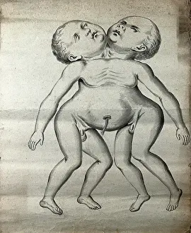 Twin Prints: Male conjoined twins joined at the neck and chest; anterior view, 1900. Creator: Unknown