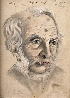 Forehead Prints: A man suffering from chancre of the lip