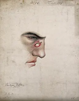 1856 Prints: A detail of a man's face seen in profile with a severe disease affecting his nose