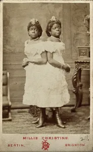 Birth Defect Prints: The Millie-Christine sisters, conjoined twins, standing, 1874. Creator: Bertin