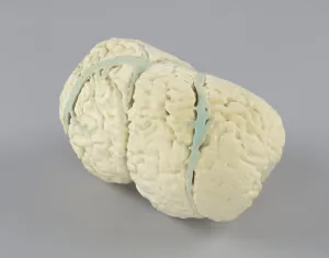 Model of the conjoined brains of Ladan and Laleh Bijani used by Dr. Ben Carson, 2003 Model of the conjoined brains of Ladan and Laleh Bijani used by Dr. Ben Carson, 2003