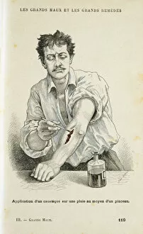 Bleeding Gallery: Painting a wound with an antiseptic solution, c1890