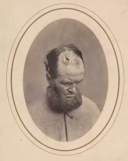 Injured Collection: Private John Parkhurst, Company E, Second New York Heavy Artillery, 1865