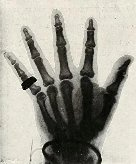 Radiograph of the Hand of H.R.H. The Prince of Wales, (c1897)
