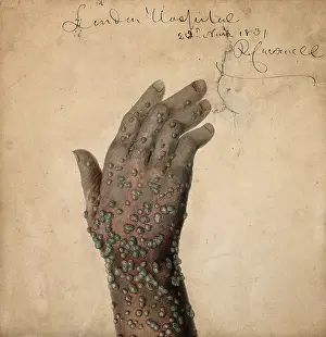 Skin Disease Prints: Rash of pustules on the hand of a patient