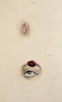 Section Prints: A section of a child's diseased forehead (detail); and a child's diseased eyebrow