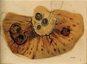 Unwell Prints: A section of diseased intestine or heart, 1800-1850. Creator: Richard Bright