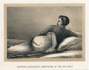 Amputee Collection: Shippens Successful Amputation at the Hip Joint, American Civil War, 1865