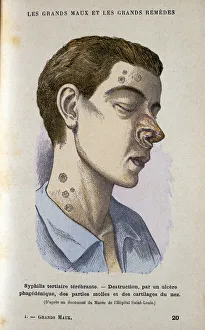 Patient Prints: Symptoms of the tertiary phase of syphilis, c19th century